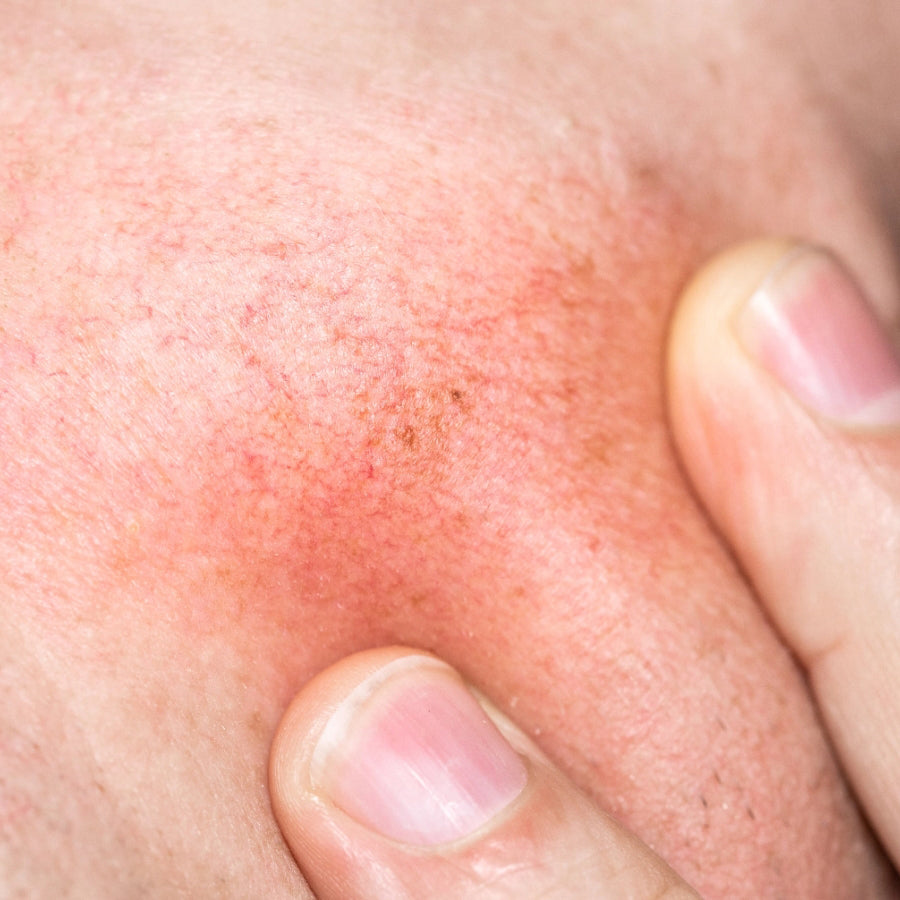Subside Redness Broken Capillaries & Redness – My Skin Lounge